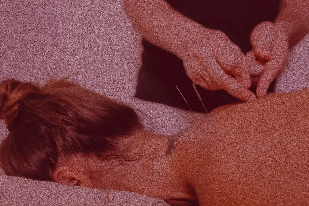Acupuncture in Rosemont Montreal