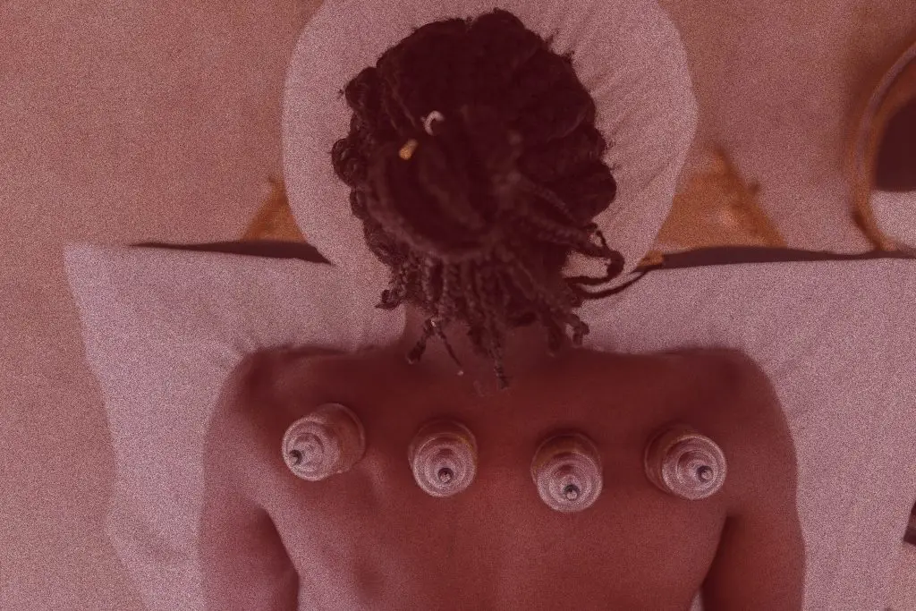 Cupping therapy at acupuncture office in Montreal