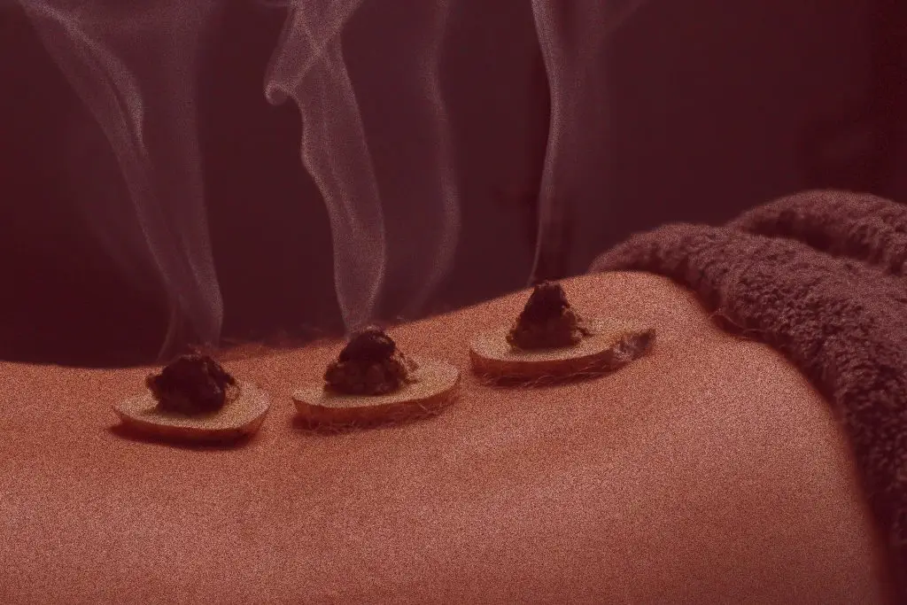 Moxibustion and Acupuncture in Rosemont, in Montreal